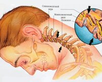 Boyun osteoxondrozu üçün vitamin kompleksi